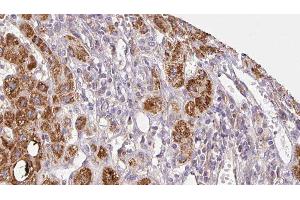 ABIN6279058 at 1/100 staining Human liver cancer tissue by IHC-P.