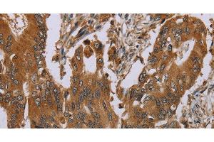 Immunohistochemistry of paraffin-embedded Human colon cancer tissue using OSM Polyclonal Antibody at dilution 1:40