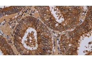 Immunohistochemistry of paraffin-embedded Human colon cancer tissue using WDR83 Polyclonal Antibody at dilution 1:60 (MORG1 antibody)
