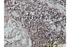 Immunoperoxidase of monoclonal antibody to ICAM3 on formalin-fixed paraffin-embedded human stomach carcinoma tissue. (ICAM-3/CD50 antibody  (AA 30-547))