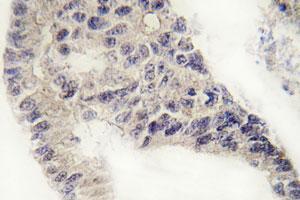 Immunohistochemical analysis of paraffin-embedded human lung cancer tissue using RCVRN polyclonal antibody . (Recoverin antibody)