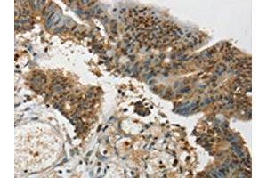 The image on the left is immunohistochemistry of paraffin-embedded Human colon cancer tissue using ABIN7192709(SYCP1 Antibody) at dilution 1/35, on the right is treated with synthetic peptide. (SYCP1 antibody)