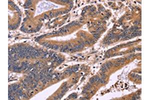 The image on the left is immunohistochemistry of paraffin-embedded Human colon cancer tissue using ABIN7130954(S100A13 Antibody) at dilution 1/40, on the right is treated with fusion protein. (S100A13 antibody)