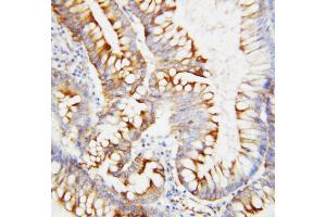 Anti-SPARC antibody, IHC(P) IHC(P): Human Intestinal Cancer Tissue (SPARC antibody  (C-Term))