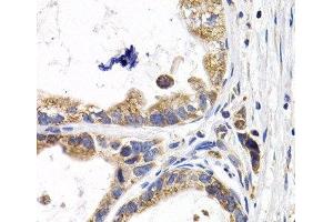 Immunohistochemistry of paraffin-embedded Human stomach cancer using FABP3 Polyclonal Antibody at dilution of 1:200 (40x lens). (FABP3 antibody)