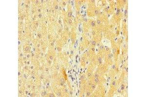 Immunohistochemistry of paraffin-embedded human liver cancer using ABIN7163953 at dilution of 1:100