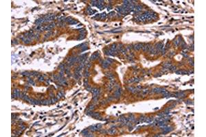 The image on the left is immunohistochemistry of paraffin-embedded Human colon cancer tissue using ABIN7129993(KIR2DL3/KIR2DL1/KIR2DL4/KIR2DS4 Antibody) at dilution 1/30, on the right is treated with fusion protein. (KIR2DL3/KIR2DL1/KIR2DL4/KIR2DS4 antibody)