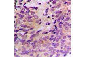 Immunohistochemical analysis of CERKL staining in human prostate cancer formalin fixed paraffin embedded tissue section. (CERKL antibody  (Center))