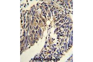 Formalin-fixed and paraffin-embedded human lung carcinoma reacted with TNFRSF14 Antibody (Center), which was peroxidase-conjugated to the secondary antibody, followed by DAB staining. (HVEM antibody  (Middle Region))