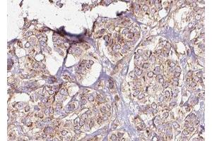 ABIN6275436 at 1/100 staining Human breast cancer tissue by IHC-P. (RAB3GAP2 antibody  (Internal Region))