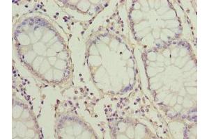Immunohistochemistry of paraffin-embedded human colon cancer using ABIN7166380 at dilution of 1:100 (ZNF767P antibody  (AA 1-118))