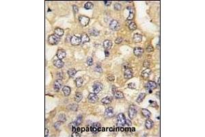 Formalin-fixed and paraffin-embedded human hepatocarcinoma tissue reacted with PFKM antibody (C-term), which was peroxidase-conjugated to the secondary antibody, followed by DAB staining. (PFKM antibody  (C-Term))