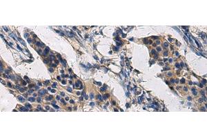 Immunohistochemistry of paraffin-embedded Human breast cancer tissue using COL17A1 Polyclonal Antibody at dilution of 1:50(x200) (COL17A1 antibody)