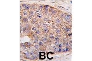 Formalin-fixed and paraffin-embedded human breast carcinoma tissue reacted with UBTD1 Antibody (C-term ) (ABIN387937 and ABIN2844471) , which was peroxidase-conjugated to the secondary antibody, followed by DAB staining. (UBTD1 antibody  (C-Term))
