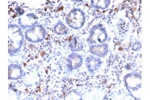 Formalin-fixed, paraffin-embedded human Gastric Carcinoma stained with MUC3 Rabbit Recombinant Monoclonal Antibody (MUC3/2992R).