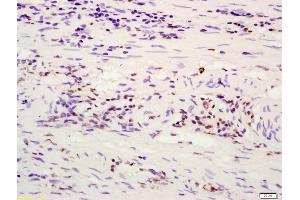 Formalin-fixed and paraffin embedded human rectal carcinoma labeled with Anti-ATF4/CREB-2 Polyclonal Antibody, Unconjugated (ABIN687862) at 1:200 followed by conjugation to the secondary antibody and DAB staining (ATF4 antibody  (AA 251-351))