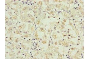 Immunohistochemistry of paraffin-embedded human gastric cancer using ABIN7162667 at dilution of 1:100 (PARD6B antibody  (AA 253-372))