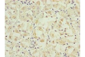 Immunohistochemistry of paraffin-embedded human gastric cancer using ABIN7162667 at dilution of 1:100