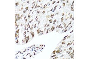 Immunohistochemistry of paraffin-embedded human prostate cancer using HNRNPR antibody (ABIN5975822) at dilution of 1/100 (40x lens). (HNRNPR antibody)