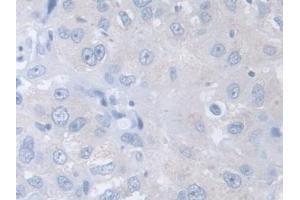 Detection of CCT2 in Human Breast cancer Tissue using Polyclonal Antibody to Chaperonin Containing TCP1, Subunit 2 (CCT2)