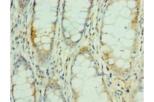Immunohistochemistry of paraffin-embedded human colon cancer using ABIN7160505 at dilution of 1:100 (MEF2C antibody  (AA 170-380))