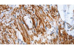 Immunohistochemistry of paraffin-embedded Human colon cancer tissue using SHROOM2 Polyclonal Antibody at dilution 1:50 (SHROOM2 antibody)