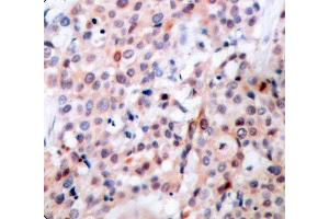 Immunohistochemistry (IHC) image for anti-B-Cell CLL/lymphoma 2 (BCL2) (pThr56) antibody (ABIN1681414) (Bcl-2 antibody  (pThr56))