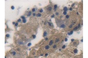 Detection of ALDH1A1 in Human Lung cancer Tissue using Polyclonal Antibody to Aldehyde Dehydrogenase 1 Family, Member A1 (ALDH1A1) (ALDH1A1 antibody  (AA 2-501))