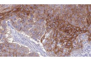 ABIN6276827 at 1/100 staining Human urothelial cancer tissue by IHC-P.