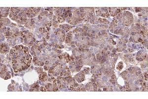 ABIN6273283 at 1/100 staining Human pancreas cancer tissue by IHC-P. (LEPREL2 antibody  (Internal Region))