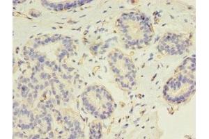 Immunohistochemistry of paraffin-embedded human breast cancer using ABIN7147264 at dilution of 1:100 (RAD17 antibody  (AA 1-270))