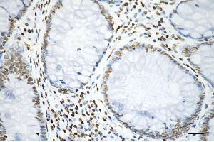 Immunohistochemistry was performed on paraffin-embedded human sigmoid colon carcinoma using histone H3 (acetyl K9) antibody (ABIN7798953), 1:200). (Recombinant Histone 3 antibody  (H3K9ac))