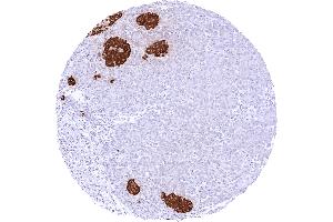 Pancreas with a strong cytoplasmic insulin staining of the majority of islet cells