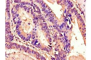 Immunohistochemistry of paraffin-embedded human colon cancer using ABIN7172930 at dilution of 1:100 (Tetraspanin 7 antibody  (AA 114-184))