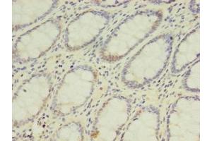 Immunohistochemistry of paraffin-embedded human colon cancer using ABIN7142126 at dilution of 1:100 (DPH2 antibody  (AA 1-489))