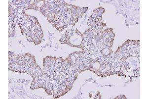 IHC-P Image Immunohistochemical analysis of paraffin-embedded human lung cancer, using FOXRED1, antibody at 1:300 dilution. (FOXRED1 antibody)