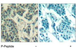 Immunohistochemical analysis of paraffin-embedded human breast carcinoma tissue using ERBB3 (phospho Y1328) polyclonal antibody . (ERBB3 antibody  (pTyr1328))