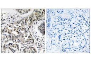 Immunohistochemistry analysis of paraffin-embedded human breast carcinoma tissue using USP6NL antibody. (USP6NL antibody  (Internal Region))