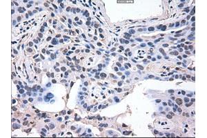 Immunohistochemical staining of paraffin-embedded Carcinoma of lung using anti-AKT3 (ABIN2452682) mouse monoclonal antibody. (AKT3 antibody  (AA 2-479))