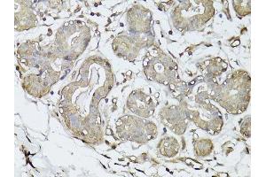 Immunohistochemistry of paraffin-embedded human breast cancer using GAPDH antibody. (GAPDH antibody  (AA 1-335))