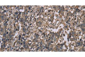 Immunohistochemistry of paraffin-embedded Human liver cancer tissue using MCC Polyclonal Antibody at dilution 1:30 (MCC antibody)