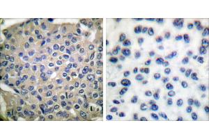 P-peptide - +Immunohistochemical analysis of paraffin-embedded human breast carcinoma tissue using Cortactin (phospho-Tyr466) antibody. (Cortactin antibody  (pTyr466))