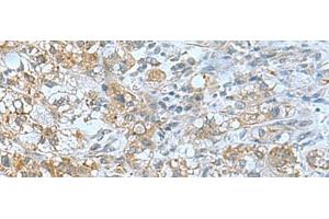 Immunohistochemistry of paraffin-embedded Human liver cancer tissue using TSGA10 Polyclonal Antibody at dilution of 1:50(x200) (TSGA10 antibody)