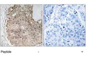 Immunohistochemistry analysis of paraffin-embedded human breast carcinoma tissue using PARP4 polyclonal antibody . (PARP4 antibody)
