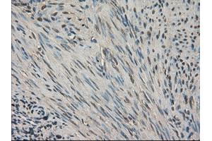 Immunohistochemical staining of paraffin-embedded Carcinoma of kidney tissue using anti-SLC18A2 mouse monoclonal antibody. (SLC18A2 antibody)