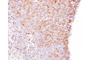 IHC-P Image Immunohistochemical analysis of paraffin-embedded H1299 xenograft , using Coronin-1B, antibody at 1:500 dilution. (CORO1B antibody)
