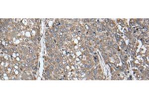 Immunohistochemistry of paraffin-embedded Human liver cancer tissue using ATAD1 Polyclonal Antibody at dilution of 1:65(x200) (ATAD1 antibody)