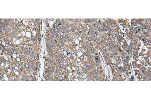 Immunohistochemistry of paraffin-embedded Human liver cancer tissue using ATAD1 Polyclonal Antibody at dilution of 1:65(x200)