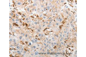 Immunohistochemistry of Human lung cancer using SLC15A2 Polyclonal Antibody at dilution of 1:60 (SLC15A2 antibody)
