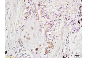 Formalin-fixed and paraffin embedded human lung carcinoma labeled with Rabbit Anti ARHGAP24 Polyclonal Antibody, Unconjugated  at 1:200 followed by conjugation to the secondary antibody and DAB staining